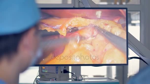 Ein Bildschirm mit laparoskopischer Chirurgie und Manipulation von Weichteilen. — Stockvideo
