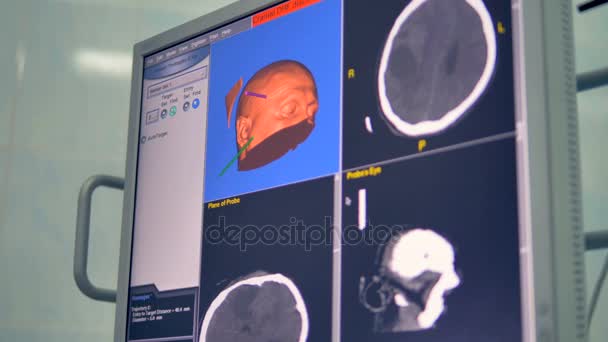 두개골 디지털 방사선 데이터 여러 가지 평면에 표시. — 비디오