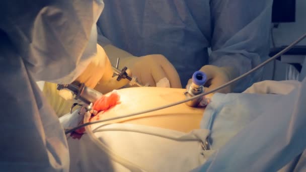 Un abdomen de pacientes brillantemente iluminado durante la laparoscopia . — Vídeos de Stock