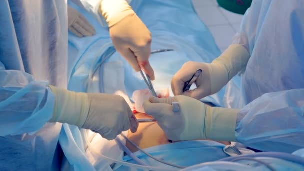 Mains de l'équipe médicale effectuant une opération chirurgicale dans la salle d'opération moderne . — Video