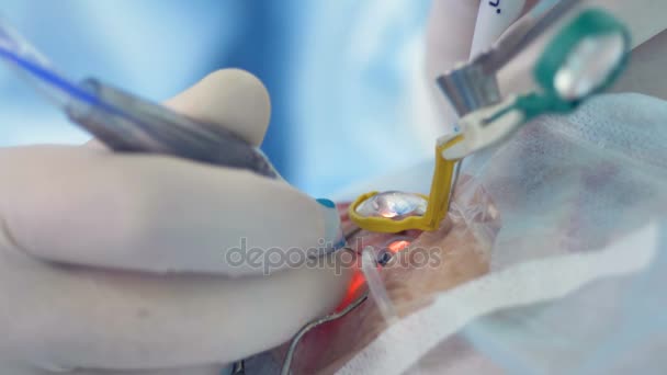 Parmakları yavaş yavaş tıbbi araçlar bir büyüteç altında bir göz ameliyatı sırasında hareket.. — Stok video