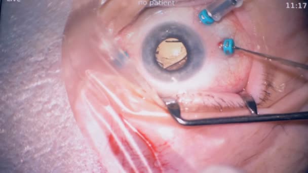 Une chirurgie de remplacement des lentilles oculaires en détail . — Video