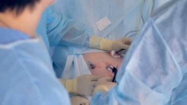 Üstten Görünüm bir abdominal Laparoskopik cerrahi.