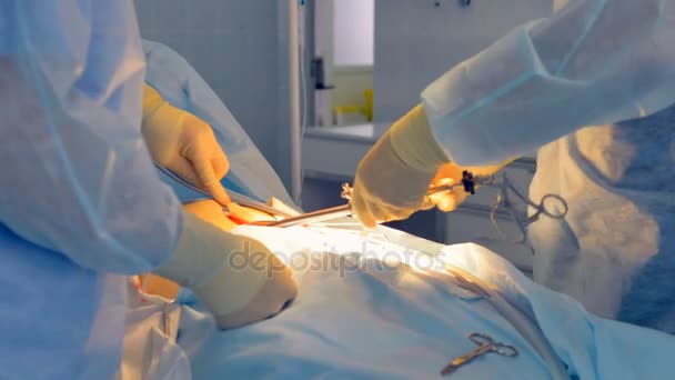 Medisch personeel verwijdert chirurgie hulpmiddelen na het beëindigen van laparoscopie. — Stockvideo