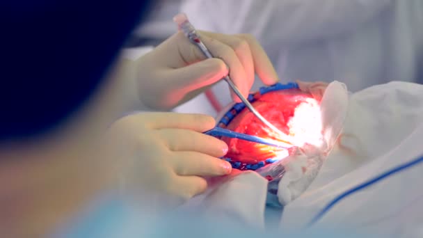 Hands in surgical gloves performing surgery using sterilized equipment. 4K. — Stock Video