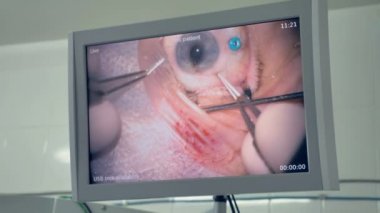 Dikiş bir göz ameliyatından sonra kolum bağlı olarak büyük bir ekran gösterir.