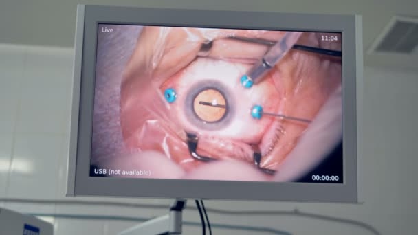 Obrazovka ukazuje makro video oční čočky chirurgické léčby. — Stock video