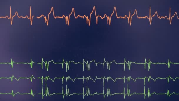 Un cardiograma real. El osciloscopio del cardiógrafo muestra la frecuencia cardíaca en una pantalla . — Vídeos de Stock