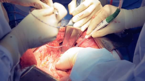 Κοντινό πλάνο της ανθρώπινης bodys εσωτερικά να πάρει λειτουργεί από μια ομάδα χειρουργών — Αρχείο Βίντεο