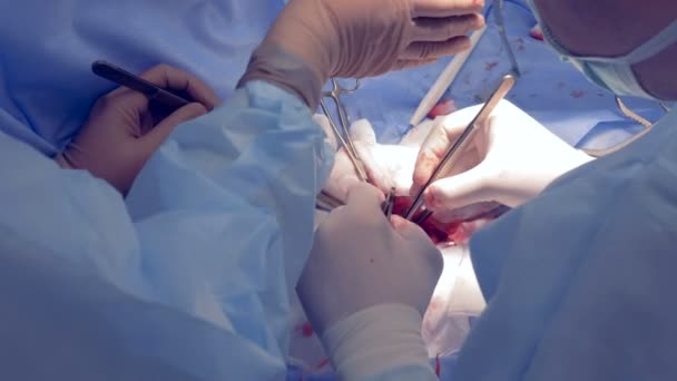 Chirurgie. Médecins perfectionnant la chirurgie. Mouvement lent . — Video