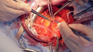 Kalp damar bir işlemi sürecinde doktorlardan oluşan bir ekip tarafından muayene ediliyor