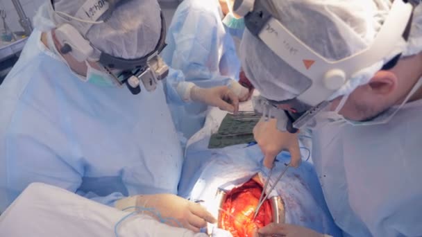 En grupp kirurger utför en åtgärd på ett mänskligt hjärta — Stockvideo