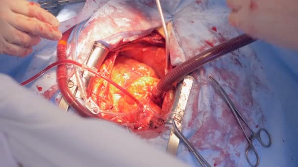Processo di un intervento chirurgico al cuore durante il quale viene regolato — Video Stock