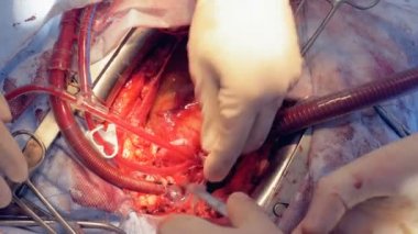 Doktorlar tüpler ayarlama ve damarlar kadar bir açık kalp ameliyatı sırasında bağlama