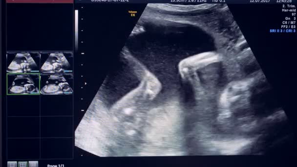 Эмбрион активно перемещает катушку на ультразвуковом изображении — стоковое видео