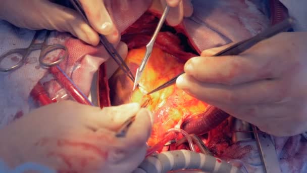 Nahaufnahme eines menschlichen Herzens, das während einer offenen Operation einen Mikroschnitt erhält — Stockvideo