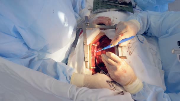 Сосудистая процедура проводится на пациенте с вскрытой грудной клеткой — стоковое видео
