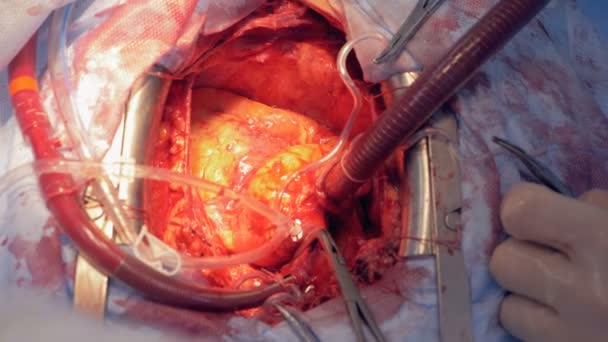 Close up of a beating heart during surgery — Stock Video