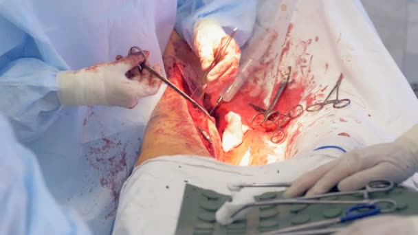 La filmación de la pierna humana siendo operada está siendo reemplazada por la imagen de un pecho operado — Vídeo de stock