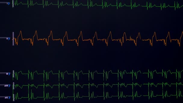 Zeilen der Vitalfrequenz, Herzfrequenz wird auf einem medizinischen Bildschirm angezeigt — Stockvideo