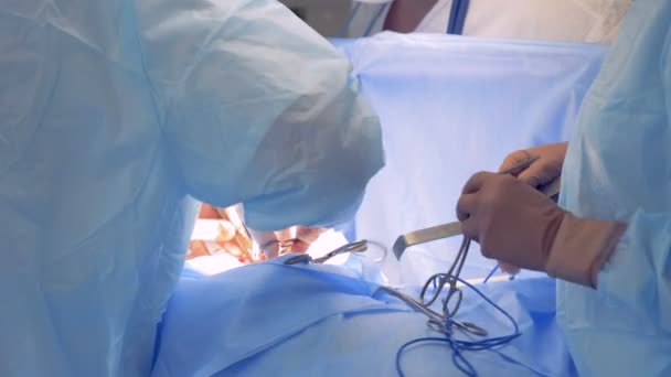 Processo de uma operação realizada por uma equipe de cirurgiões — Vídeo de Stock