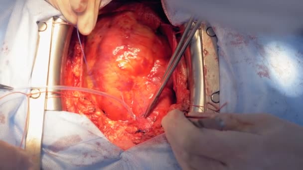 Surgeons are sewing up human heart while operating it — Stock Video