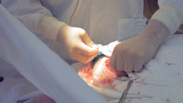 Vezels in een open wond van een patiënt zijn steeds naaide omhoog door een arts — Stockvideo