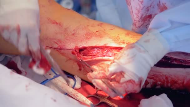 Procedimento de bypass vascular realizado por um cirurgião — Vídeo de Stock