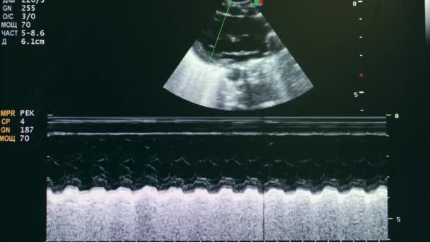 Examen ecográfico del corazón de un bebé . — Vídeos de Stock