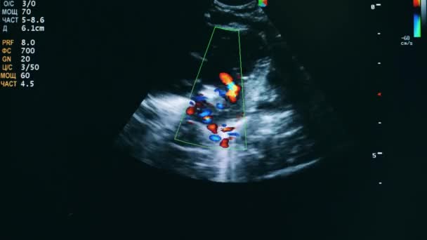 Image échographique sur un écran d'ordinateur — Video