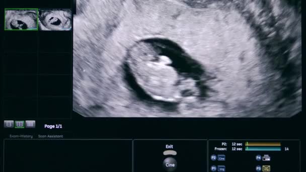 Unborn baby on the ultrasonic image — Stock Video