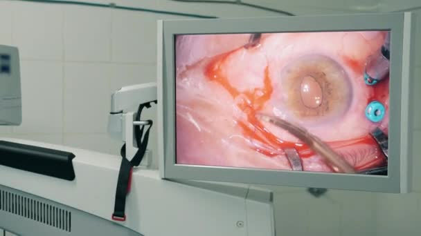 Processo de cirurgia ocular em uma tela médica . — Vídeo de Stock