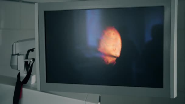 En monitor i ett kirurgiskt rum under en operation. — Stockvideo