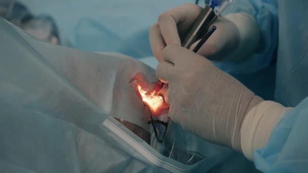 Un chirurgien travaillant avec un œil de patient dans une clinique . — Video