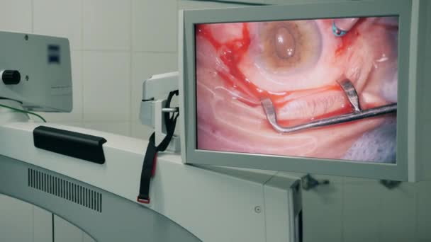 Tela de computador com um curso de uma cirurgia ocular mostrada nele — Vídeo de Stock