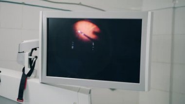 Göz küresindeki işlem ekranda gösterilir