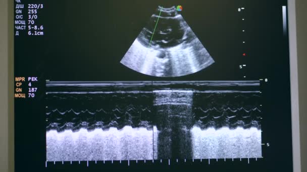 Screening eines Ultraschallmechanismus bei der Arbeit — Stockvideo