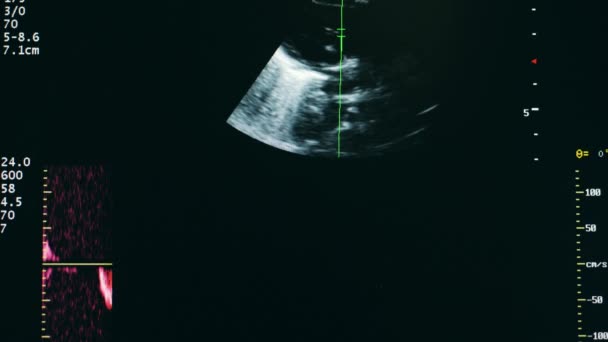 Dynamic radar during an ultrasound procedure — 비디오