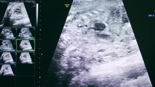 Immagine acquisita sullo schermo della macchina ad ultrasuoni — Video Stock