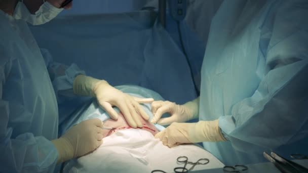 Kirurger skär patienter magen — Stockvideo