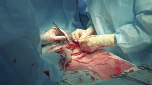 Cerrahlar hastaların midesine dikiş atıyorlar. — Stok video