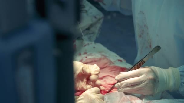 Рана пациента зашивается во время операции — стоковое видео