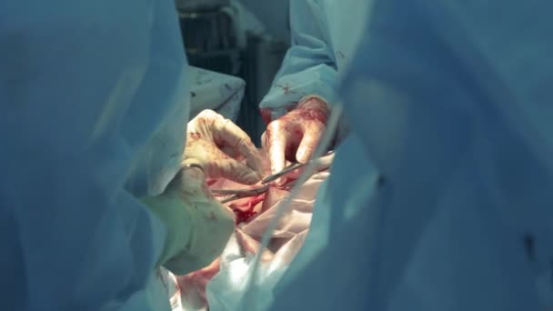 Surgical procedure with stitching performed by the doctors — Stock video