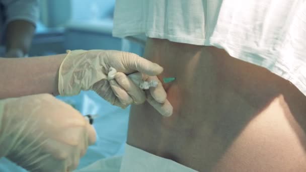 척추 마취, 경막외 마취. 환자에게서 바늘을 삽입하여 제거하는 모습 — 비디오