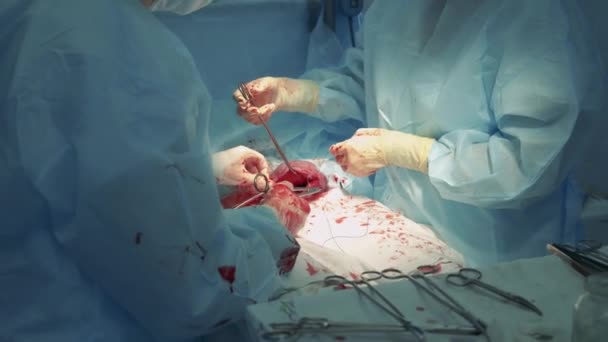 Χειρουργοί εκτελούν μια χειρουργική επέμβαση σε ένα νοσοκομείο. — Αρχείο Βίντεο