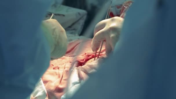 Cirujanos trabajando en un hospital, realizando cirugía . — Vídeo de stock