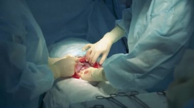 Cerrahlar bir hastaya sezaryen yapıyorlar.