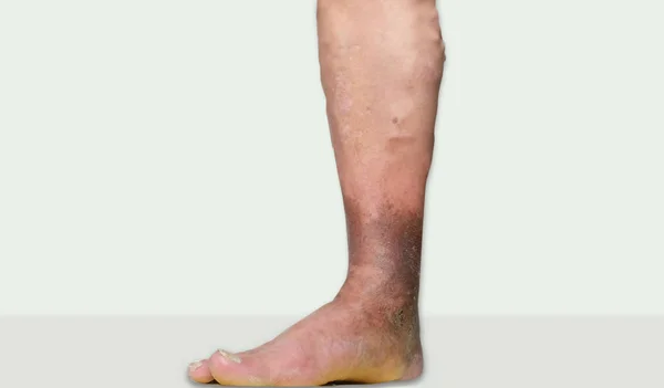 varicose bruise picioare)