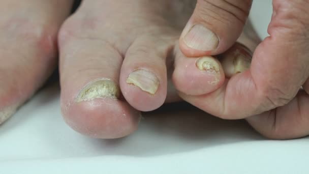 Onicomicosis. Infección fúngica de las uñas de los pies — Vídeo de stock