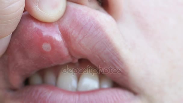 Κοντινό πλάνο της στοματίτιδας στο στόμα — Αρχείο Βίντεο
